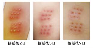 日本ビーシージー製造株式会社 Japan BCG Laboratory