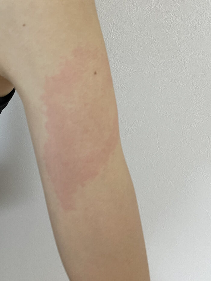 モデルナワクチン1回目の接種後に起きた体調不良をまとめています。
この画像は13日目に突然発生したモデルナアームの画像です。痛みはなく広範囲の痒みに悩まされています。
妻に起きた症例は接種した腕の裏側全体の筋が引っ張られるような痛み、脇の下の痛み、胸の痛み、下痢、熱、突然の動悸、息切れ、眩暈に悩まされて2週間経った現在も日常生活に支障をきたすほどの体調不良に悩まされています。
